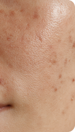 칙칙한 기미 자국